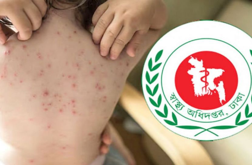 হাম উপসর্গে পাঁচ বিভাগে ৭ জনের মৃত্যু